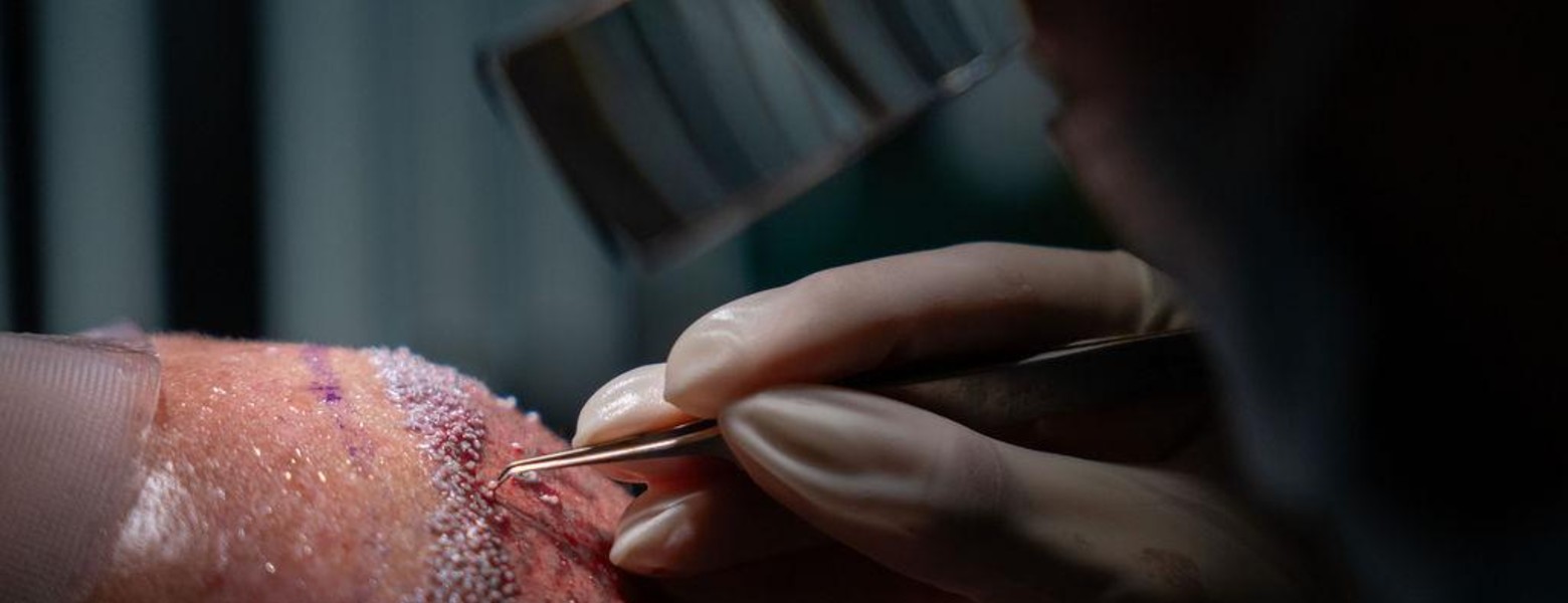 Foto de Injertae | Clínica trasplante capilar Málaga en Málaga - Imagen 9