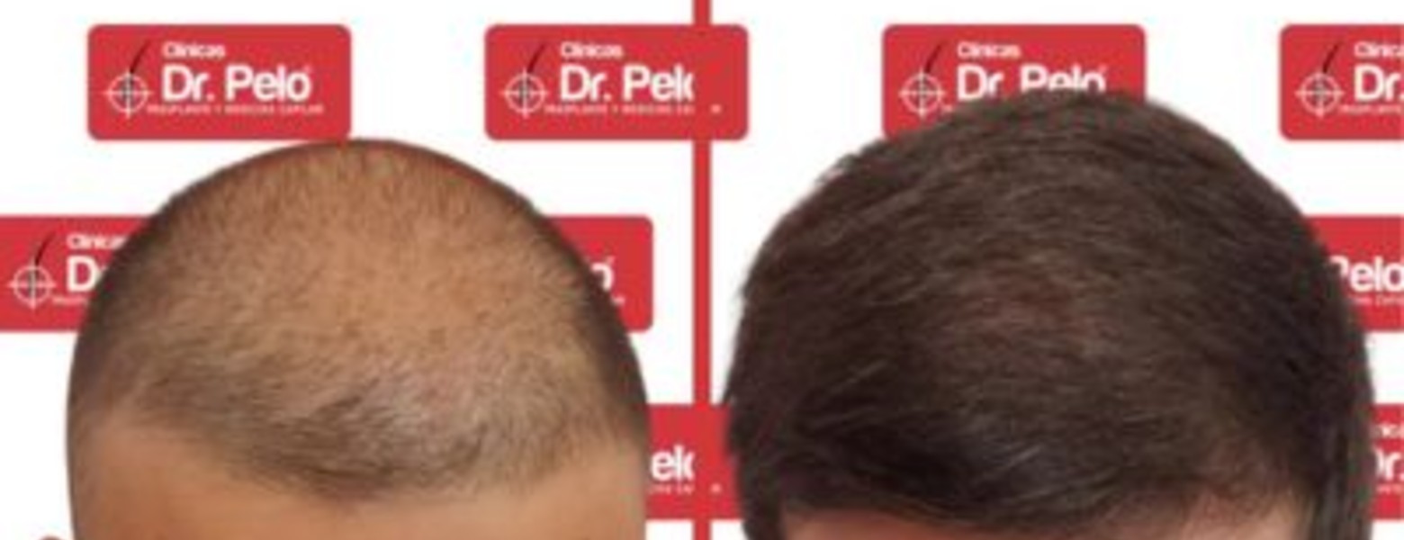 Foto de Clínicas Dr Pelo Trasplante y Medicina Capilar en Sevilla - Imagen 5