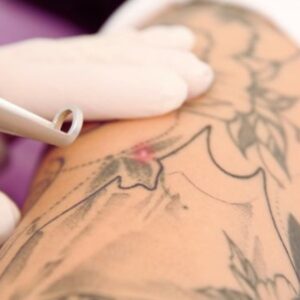 Foto de Remove Málaga Eliminación de Tatuajes en Málaga - Imagen 2
