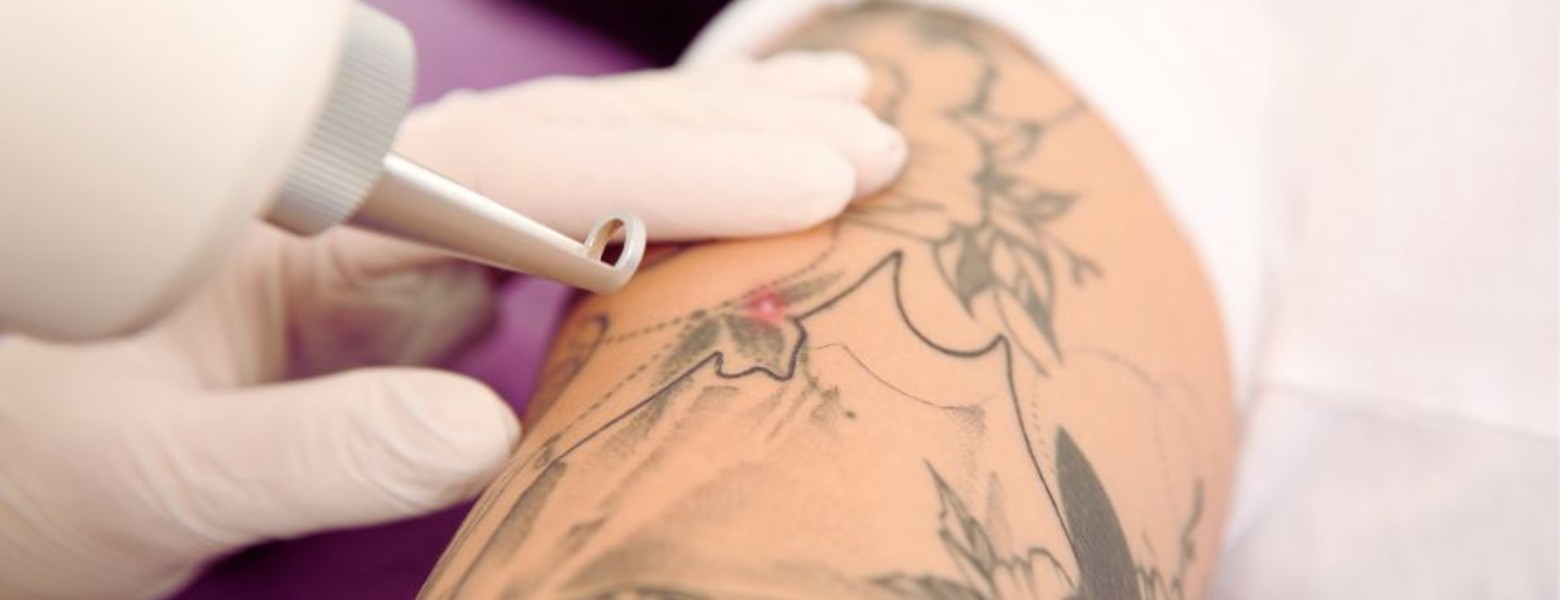 Foto de Remove Málaga Eliminación de Tatuajes en Málaga - Imagen 2