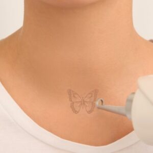 Foto de Remove Málaga Eliminación de Tatuajes en Málaga - Imagen 1