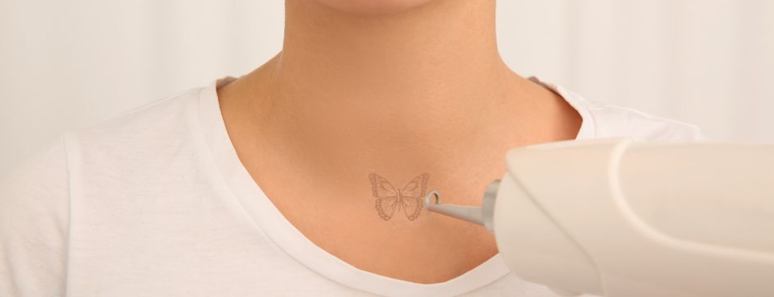 Foto de Remove Málaga Eliminación de Tatuajes en Málaga - Imagen 1