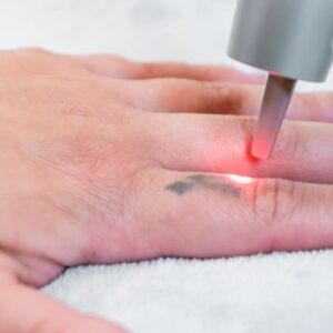 Foto de Remove Málaga Eliminación de Tatuajes en Málaga - Imagen 5