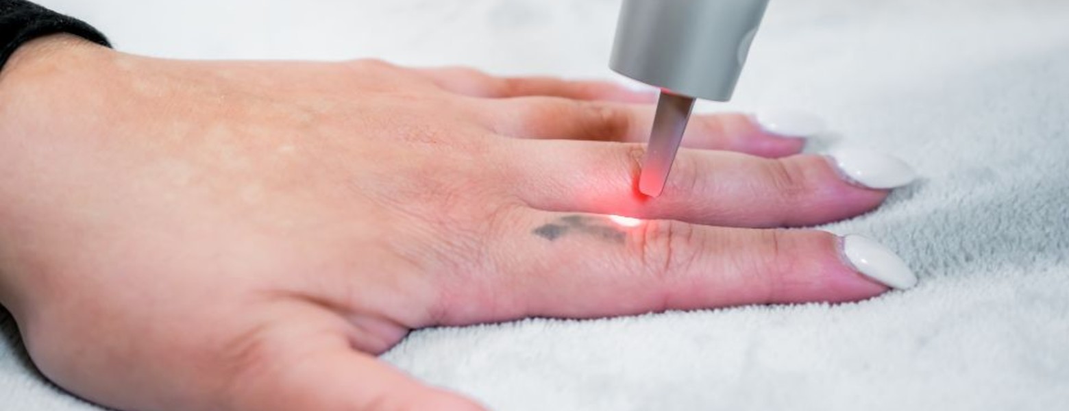 Foto de Remove Málaga Eliminación de Tatuajes en Málaga - Imagen 5