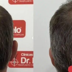 Foto de Clínicas Dr. Pelo - Clínica Capilar en Badajoz Injerto Capilar en Badajoz - Imagen 4