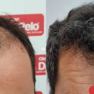 Foto de Clínicas Dr. Pelo - Clínica Capilar en Badajoz Injerto Capilar en Badajoz - Imagen 3