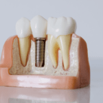 Implantes Cigomaticos Net Implantes Cigomaticos Net