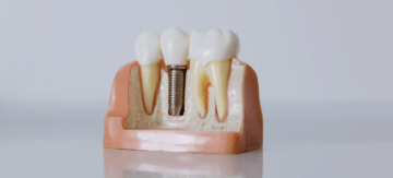 Implantes Cigomaticos Net - Clínica dental en Madrid Implantes Cigomaticos Net - Clínica dental en Madrid