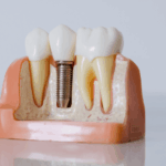 Implantes Cigomaticos Net - Clínica dental en Madrid