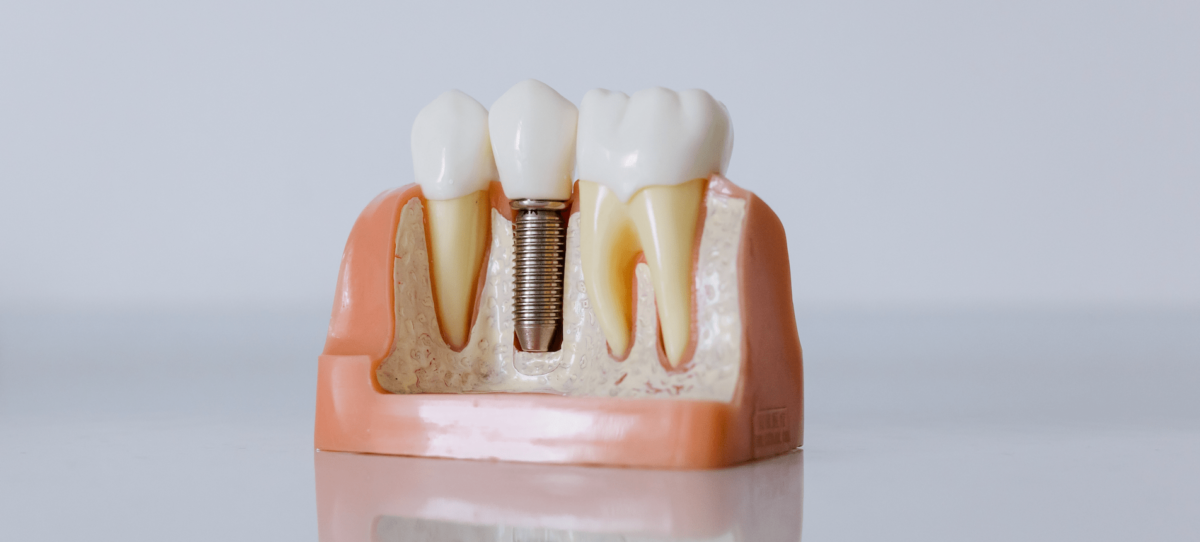 Imagen de Implantes Cigomaticos Net