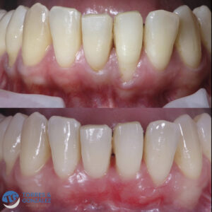 Foto de Clínicas Torres & González🦷Carillas dentales Granada 🪥 Implantes dentales. en Granada - Imagen 6