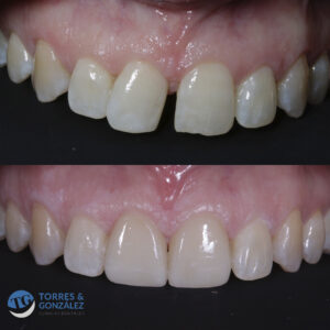 Foto de Clínicas Torres & González🦷Carillas dentales Granada 🪥 Implantes dentales. en Granada - Imagen 7